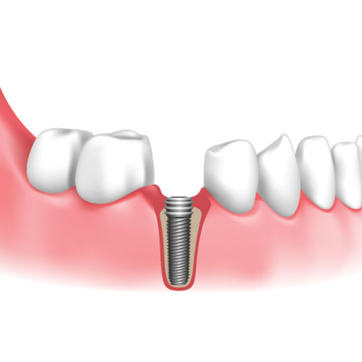 IMPLANT PLACEMENT